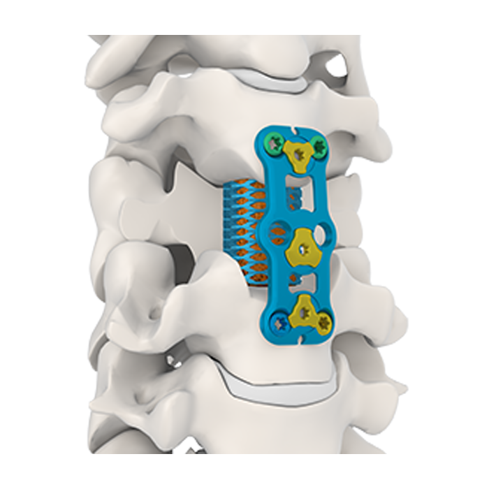 MaxAn Anterior Cervical Plate System