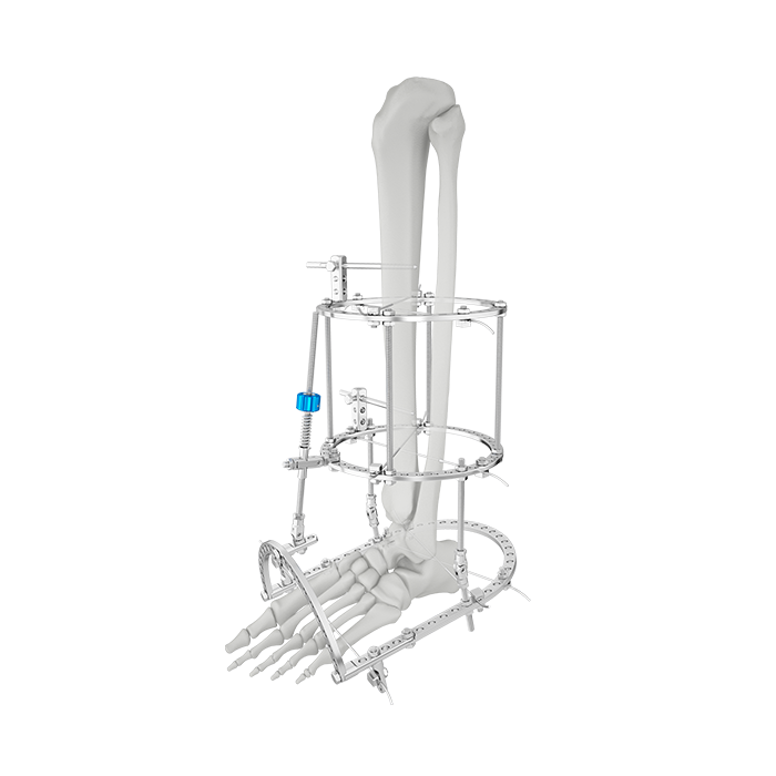 Ilizarov TrueLok Ring Fixation System Distraction Osteogenesis Ring System