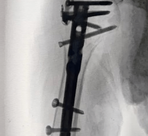 Dzielenie się przypadkiem: Pierwszy gwóźdź śródszpikowy z kulką panewki kości ramiennej w złamaniu bliższego końca kości ramiennej w Chinach