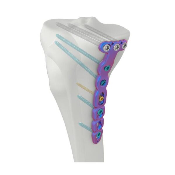 VAL Proximal Medial Tibial Locking Plate