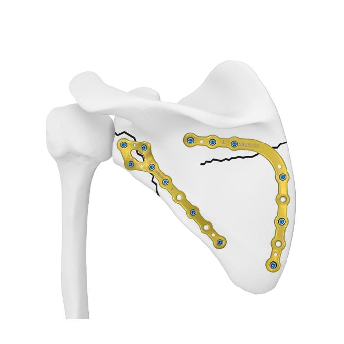 Scapula Medial Locking Plate