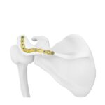 Acromion Locking Plate