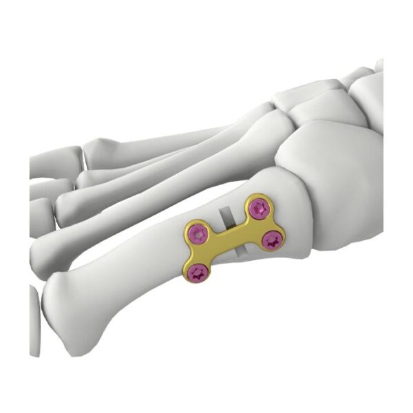 Itval Pierwsza Kość Śródstopia Płytka Blokująca do Osteotomii